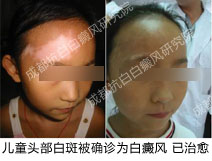 �ɶ��װ�ҽԺ,�װ߰װ���ͭԪ�صĹ�ϵ,ͼΪ��ͯͷ���װ߰װ����ƶԱ�