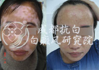 成都白斑医院,白斑治疗选什么医院好(图),图为女性面部白斑白斑治疗对比
